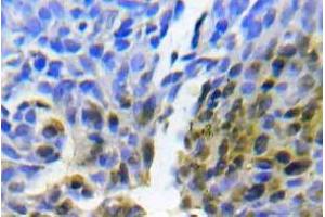 Immunohistochemistry (IHC) analyzes of Abl1 antibody in paraffin-embedded human lung adenocarcinoma tissue. (ABL1 抗体)