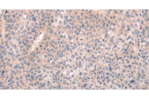 Immunohistochemistry of paraffin-embedded Human liver cancer tissue using ABCF1 Polyclonal Antibody at dilution 1:40 (ABCF1 抗体)