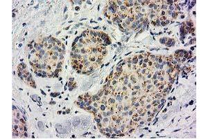 Immunohistochemical staining of paraffin-embedded Adenocarcinoma of Human breast tissue using anti-BECN1 mouse monoclonal antibody. (Beclin 1 抗体)