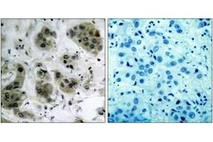 Immunohistochemistry analysis of paraffin-embedded human breast carcinoma tissue, using Akt (Ab-473) Antibody. (AKT1 抗体  (AA 431-480))