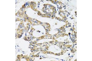 Immunohistochemistry of paraffin-embedded human colon carcinoma using SSBP1 antibody (ABIN5974202) at dilution of 1/100 (40x lens). (SSBP1 抗体)