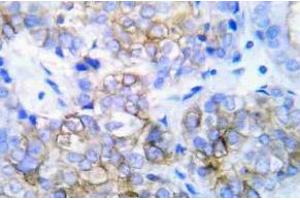 Immunohistochemistry (IHC) analyzes of HER2 pAb in paraffin-embedded human lung adenocarcinoma tissue. (ErbB2/Her2 抗体)