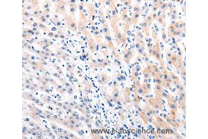 Immunohistochemistry of Human liver cancer using MTOR Polyclonal Antibody at dilution of 1:60 (MTOR 抗体)