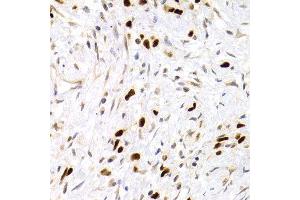 Immunohistochemistry of paraffin-embedded human gastric carcinoma using TP53 antibody at dilution of 1:200 (400x lens). (p53 抗体)