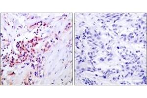 Immunohistochemistry analysis of paraffin-embedded human breast carcinoma, using NF-kappaB p65 (Phospho-Ser468) Antibody. (NF-kB p65 抗体  (pSer468))