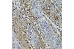 Immunohistochemistry of paraffin-embedded human esophageal cancer using COL1A1 antibody (ABIN5997480) at dilution of 1/100 (40x lens). (COL1A1 抗体)