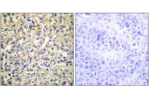 Immunohistochemistry analysis of paraffin-embedded human liver carcinoma tissue, using DUSP9 Antibody. (DUSP9 抗体  (AA 151-200))