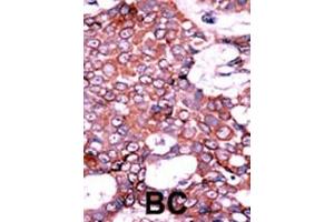 Formalin-fixed and paraffin-embedded human cancer tissue reacted with the primary antibody, which was peroxidase-conjugated to the secondary antibody, followed by AEC staining. (CDC25A 抗体  (pSer75))