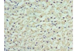 Immunohistochemistry of paraffin-embedded human liver cancer using ABIN7167852 at dilution of 1:100 (RBP4 抗体  (AA 19-201))