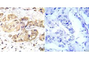Immunohistochemical analysis of paraffin- embedded human breast carcinoma tissue using LKB1 (Ab-428) antibody (E022046). (LKB1 抗体)