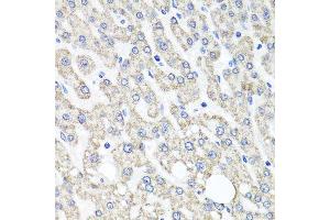 Immunohistochemistry of paraffin-embedded human liver injury using OTC antibody (ABIN6003566) at dilution of 1/100 (40x lens). (OTC 抗体)