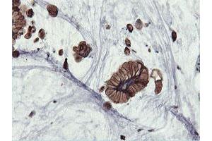 Immunohistochemical staining of paraffin-embedded Adenocarcinoma of Human colon tissue using anti-PFKP mouse monoclonal antibody. (PFKP 抗体)