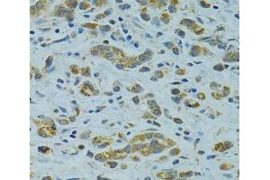 Immunohistochemistry of paraffin-embedded Human gastric cancer using STX1A Polyclonal Antibody at dilution of 1:100 (40x lens). (STX1A 抗体)