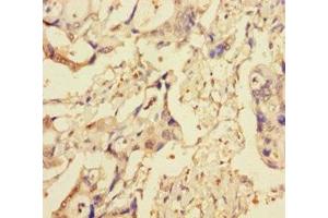 Immunohistochemistry of paraffin-embedded human pancreatic cancer using ABIN7151314 at dilution of 1:100 (XIAP 抗体  (AA 1-497))