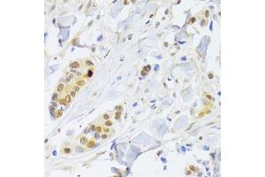 Immunohistochemistry of paraffin-embedded human breast cancer using RELA Antibody. (NF-kB p65 抗体)