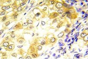 Immunohistochemistry (IHC) analyzes of P53 antibody in paraffin-embedded human lung carcinoma tissue. (p53 抗体)