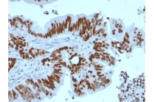 Immunohistochemistry (IHC) image for anti-Tumor Protein P53 (TP53) antibody (ABIN6940792)