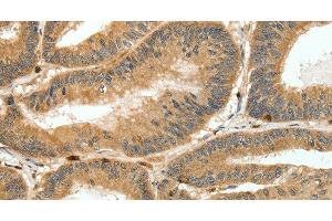 Immunohistochemistry of paraffin-embedded Human colon cancer tissue using S100A4 Polyclonal Antibody at dilution 1:80 (s100a4 抗体)