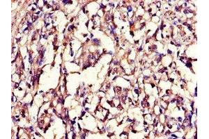 Immunohistochemistry of paraffin-embedded human gastric cancer using ABIN7157854 at dilution of 1:100 (Lamin B1 抗体  (AA 385-552))