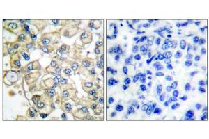 Immunohistochemical analysis of paraffin-embedded human breast carcinoma tissue, using FGFR1 Oncogene Partner antibody (ABIN5976395). (FGFR1OP 抗体  (C-Term))