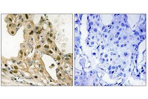 Immunohistochemistry analysis of paraffin-embedded human breast carcinoma tissue using p53 (Phospho-Thr387) antibody. (p53 抗体  (pThr387))