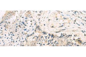 Immunohistochemistry of paraffin-embedded Human cervical cancer tissue using MGAT4B Polyclonal Antibody at dilution of 1:50(x200) (MGAT4B 抗体)