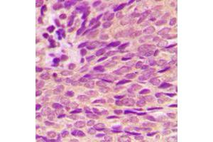 Immunohistochemical analysis of Estrogen Receptor alpha (pS118) staining in human breast cancer formalin fixed paraffin embedded tissue section. (Estrogen Receptor alpha 抗体  (pSer118))