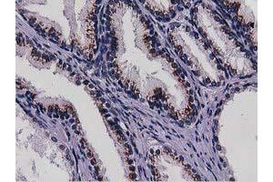 Immunohistochemical staining of paraffin-embedded Carcinoma of Human kidney tissue using anti-NT5DC1 mouse monoclonal antibody. (NT5DC1 抗体)