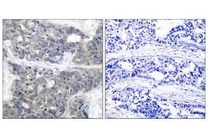 Immunohistochemical analysis of paraffin-embedded human breast carcinoma tissue using p70 S6 Kinase (phospho-Thr421) antibody (E011254). (RPS6KB1 抗体  (pThr421))