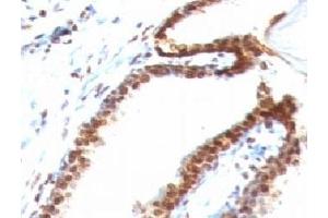 Formalin-fixed, paraffin-embedded human colon carcinoma stained with Double Stranded DNA antibody (DSD/958) (dsDNA 抗体)