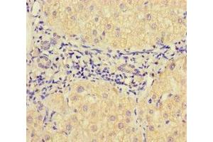 Immunohistochemistry of paraffin-embedded human liver cancer using ABIN7175471 at dilution of 1:100 (VAMP1 抗体  (AA 1-96))