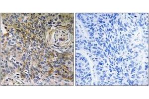 Immunohistochemistry analysis of paraffin-embedded human breast carcinoma tissue, using CD147 Antibody. (CD147 抗体  (AA 336-385))