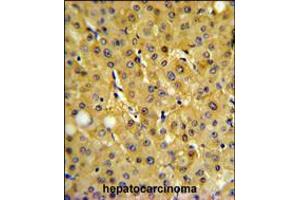 FBP1 Antibody IHC analysis in formalin fixed and paraffin embedded human hepatocarcinoma followed by peroxidase conjugation of the secondary antibody and DAB staining. (FBP1 抗体  (AA 125-156))