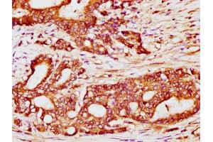 IHC image of ABIN7174242 diluted at 1:200 and staining in paraffin-embedded human colon cancer performed on a Leica BondTM system. (COQ3 抗体  (AA 271-369))
