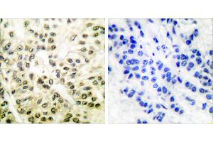 Peptide - +Immunohistochemical analysis of paraffin-embedded human breast carcinoma tissue using CREB (Ab-129/133) antibody (#B7053). (CREB1 抗体  (Ser129, Ser133))