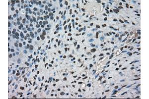 Immunohistochemical staining of paraffin-embedded Carcinoma of kidney tissue using anti-FERMT2mouse monoclonal antibody. (FERMT2 抗体)