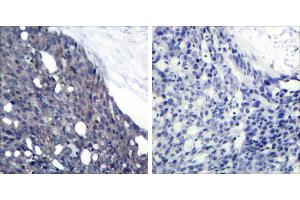 Peptide - +Immunohistochemical analysis of paraffin-embedded human breast carcinoma tissue using IκB-α (Ab-42) antibody (#B7116). (NFKBIA 抗体  (Tyr42))