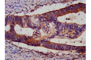 IHC image of ABIN7145547 diluted at 1:1200 and staining in paraffin-embedded human colon cancer performed on a Leica BondTM system. (BID 抗体  (AA 1-195))