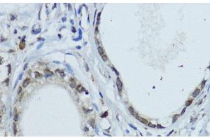 Immunohistochemistry of paraffin-embedded Human gastric cancer using NR1I3 Polyclonal Antibody at dilution of 1:200 (40x lens). (NR1I3 抗体)