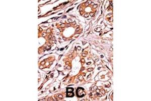 Formalin-fixed and paraffin-embedded human cancer tissue reacted with the primary antibody, which was peroxidase-conjugated to the secondary antibody, followed by AEC staining. (Retinoblastoma 1 抗体  (pSer249))