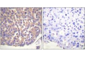 Immunohistochemistry analysis of paraffin-embedded human breast carcinoma tissue, using Filamin A (Ab-2152) Antibody. (Filamin A 抗体  (AA 2121-2170))