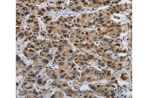 Immunohistochemistry of Human liver cancer using HNRNPL Polyclonal Antibody at dilution of 1:40 (HNRNPL 抗体)