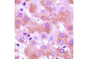 Immunohistochemical analysis of FURIN staining in human liver cancer formalin fixed paraffin embedded tissue section. (FURIN 抗体)
