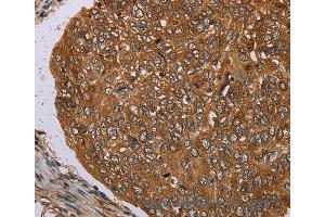 Immunohistochemistry of Human esophagus cancer using PIM3 Polyclonal Antibody at dilution of 1:35 (PIM3 抗体)