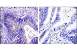 Immunohistochemistry analysis of paraffin-embedded human colon carcinoma, using ATP-Citrate Lyase (Phospho-Ser454) Antibody. (ACLY 抗体  (pSer455))