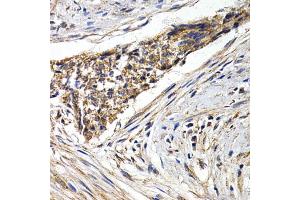 Immunohistochemistry of paraffin-embedded human esophagus cancer using FZR1 antibody (ABIN5973232) at dilution of 1/200 (40x lens). (FZR1 抗体)