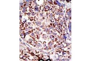 Formalin-fixed and paraffin-embedded human cancer tissue reacted with the primary antibody, which was peroxidase-conjugated to the secondary antibody, followed by DAB staining. (USP3 抗体  (C-Term))