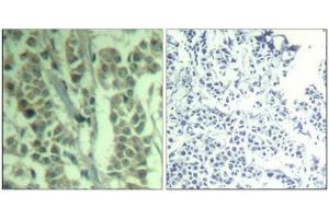 Immunohistochemical analysis of paraffin-embedded human breast carcinoma tissue using c-Cbl(Phospho-Tyr700) Antibody(left) or the same antibody preincubated with blocking peptide(right). (CBL 抗体  (pTyr770))