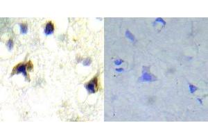 Immunohistochemical analysis of paraffin- embedded human brain carcinoma tissue using PDGFR beta (Ab-751) antibody (E022033). (PDGFRB 抗体)