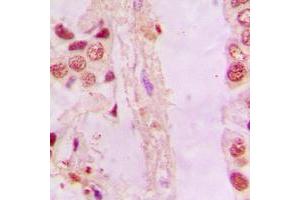 Immunohistochemical analysis of NRF2 staining in human lung cancer formalin fixed paraffin embedded tissue section. (NRF2 抗体  (C-Term))